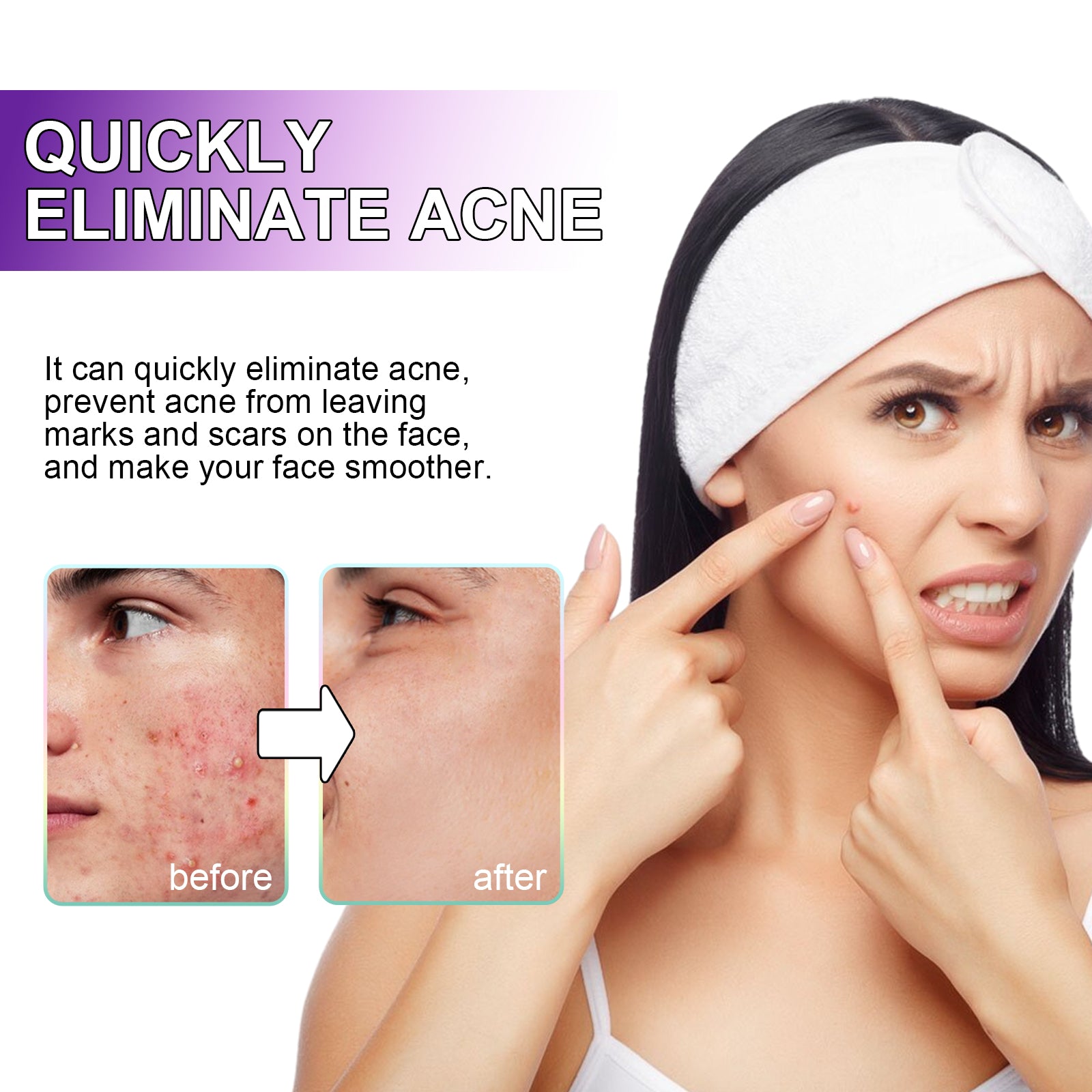 [vendor] Space Edition Acne Patches, 180 Pcs Hydrocolloid Pimple