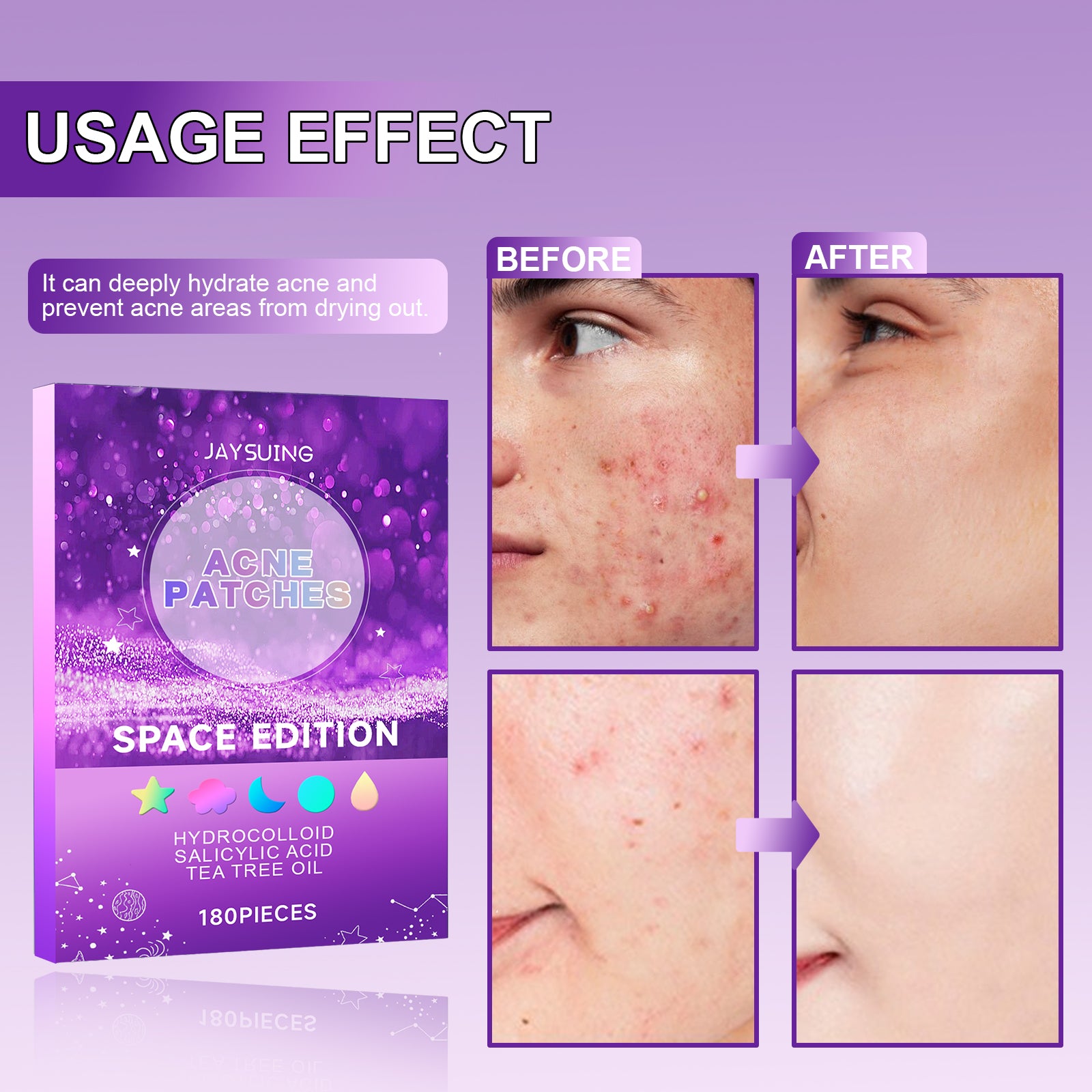 [vendor] Space Edition Acne Patches, 180 Pcs Hydrocolloid Pimple
