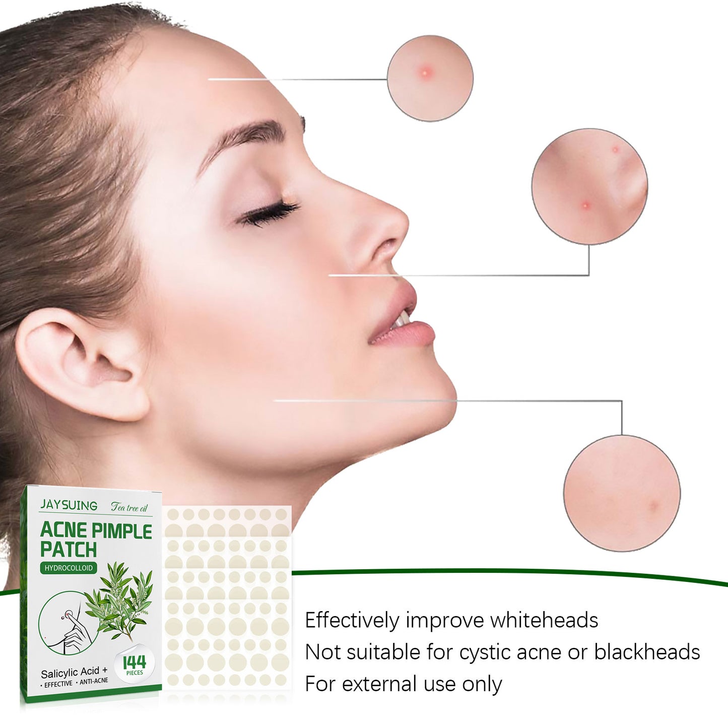 [vendor] Acne Pimple Patches, Hydrocolloid Acne Patches With Tea