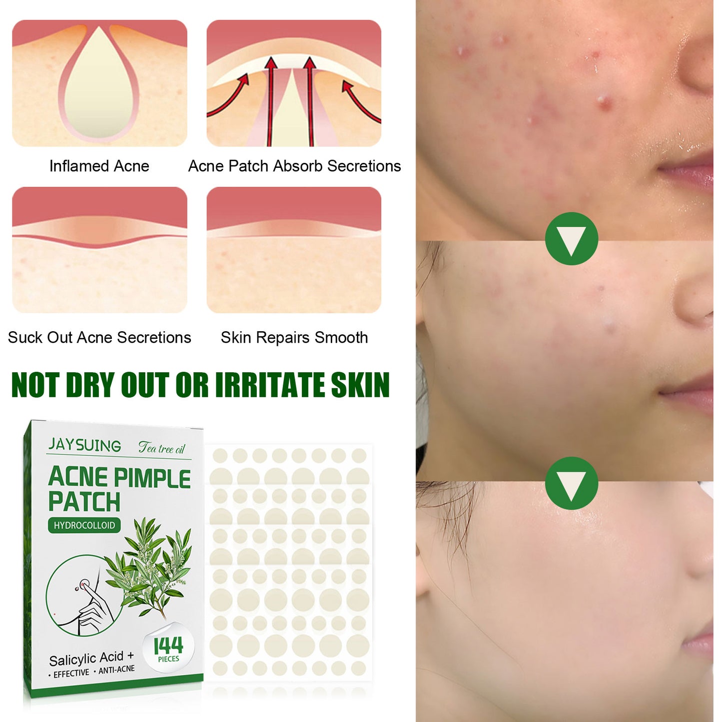 [vendor] Acne Pimple Patches, Hydrocolloid Acne Patches With Tea