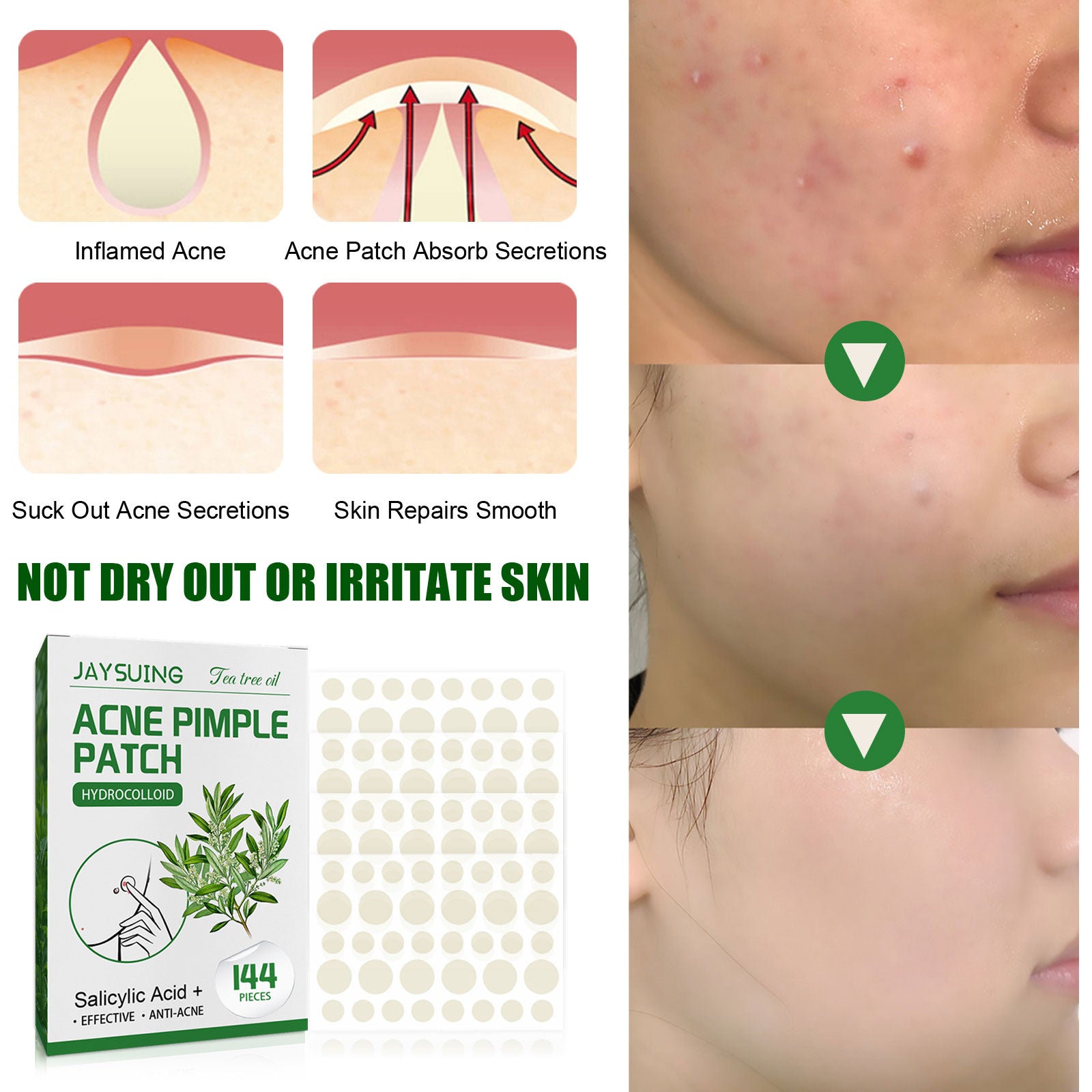 [vendor] Acne Pimple Patches, Hydrocolloid Acne Patches With Tea